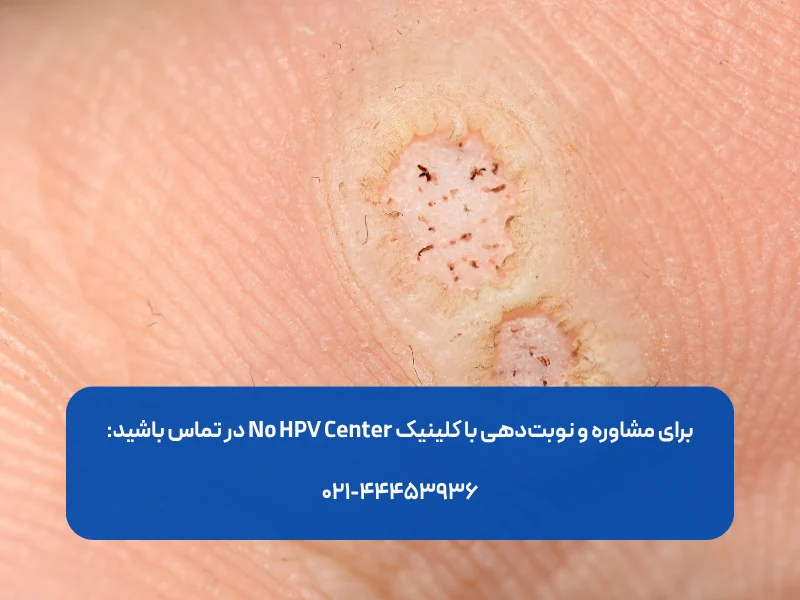 بعد از لیزر زگیل تناسلی چه کنیم